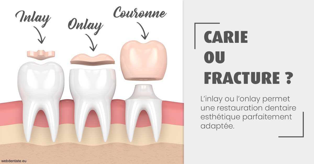 https://dr-courtois-roland.chirurgiens-dentistes.fr/T2 2023 - Carie ou fracture 1
