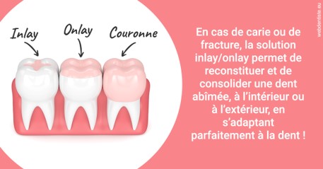 https://dr-courtois-roland.chirurgiens-dentistes.fr/L'INLAY ou l'ONLAY 2