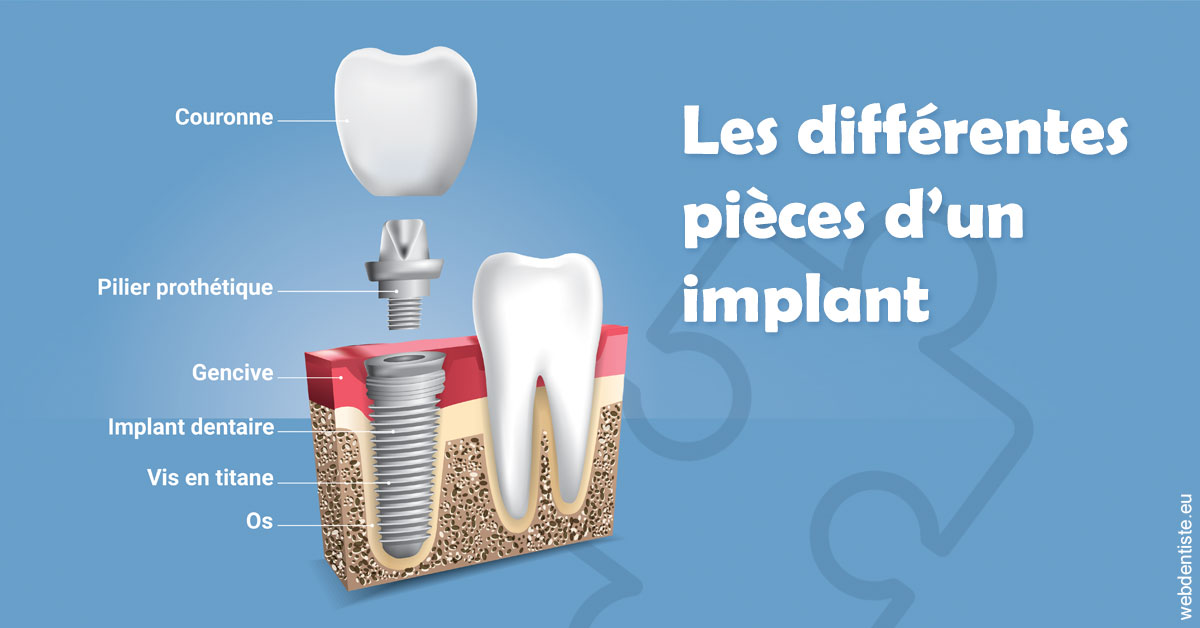 https://dr-courtois-roland.chirurgiens-dentistes.fr/Les différentes pièces d’un implant 1